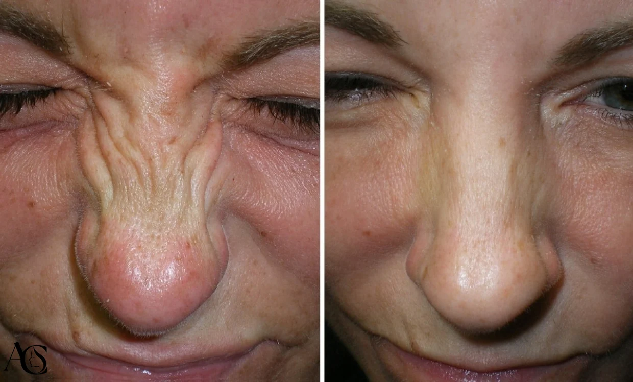 Bunny lines Botox in Playa del carmen®- AgeEssence Medical Center in playa del carmen