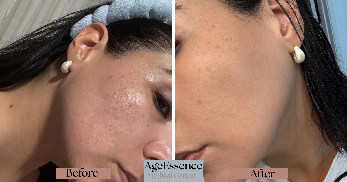 _Salmon PDRN Skin Renewal and Radiance - AgeEssence Medical Center